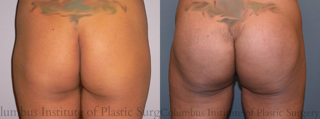 Buttock Augmentation before and after photo by Institute of Plastic Surgery in Columbus OH