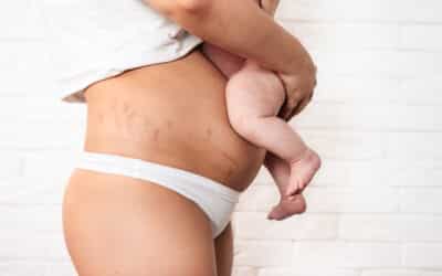 How a Belt Lipectomy Helps Women After Pregnancy