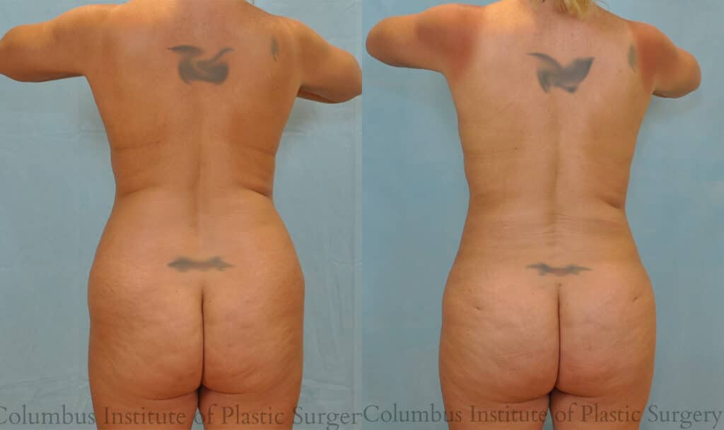 Fat grafting to buttock and liposuction before and after photo by Institute of Plastic Surgery in Columbus OH