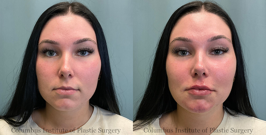 Lip Augmentation before and after photo by Columbus Institute of Plastic Surgery in Columbus OH