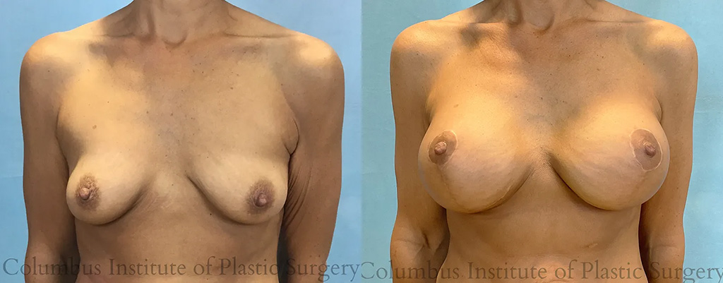 Front View Mastopexy with Implants before and after photo by Institute of Plastic Surgery