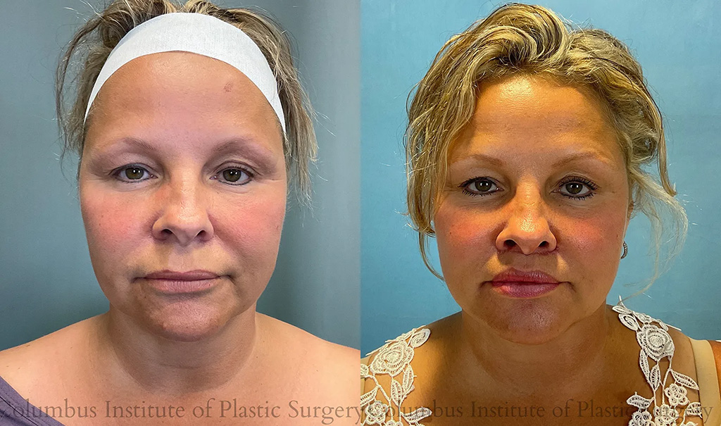 Front View Neck Lift before and after photo by Institute of Plastic Surgery