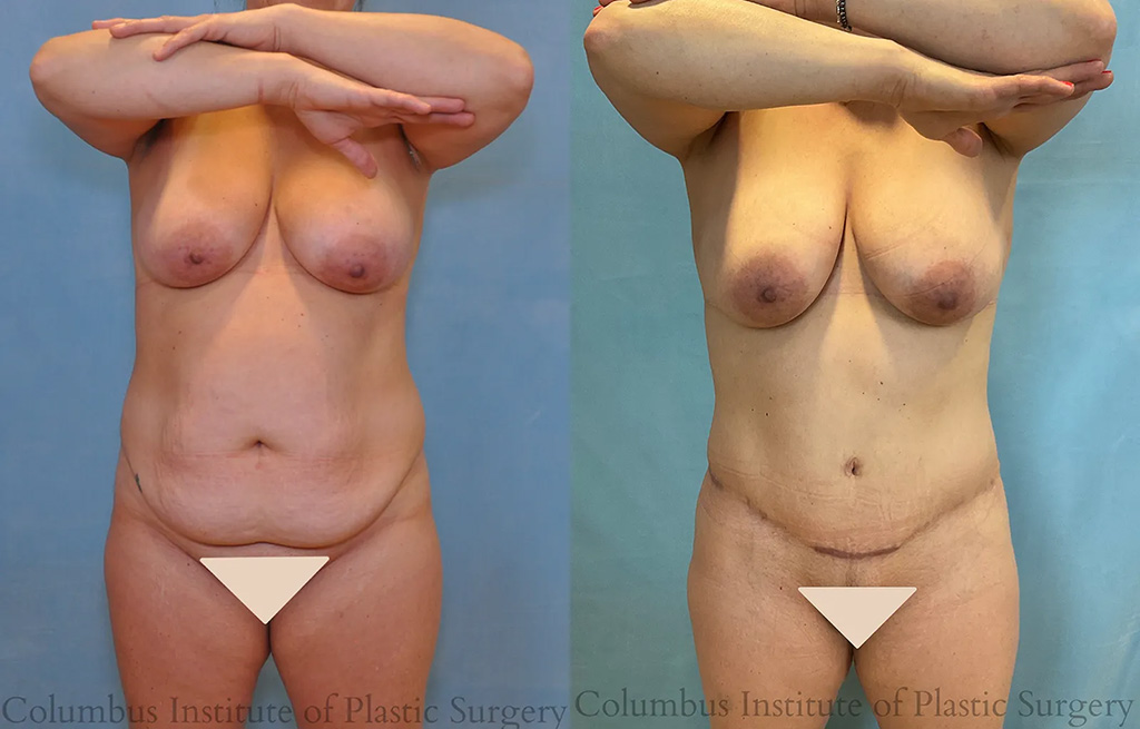 Front View Tummy Tuck before and after photo by Institute of Plastic Surgery